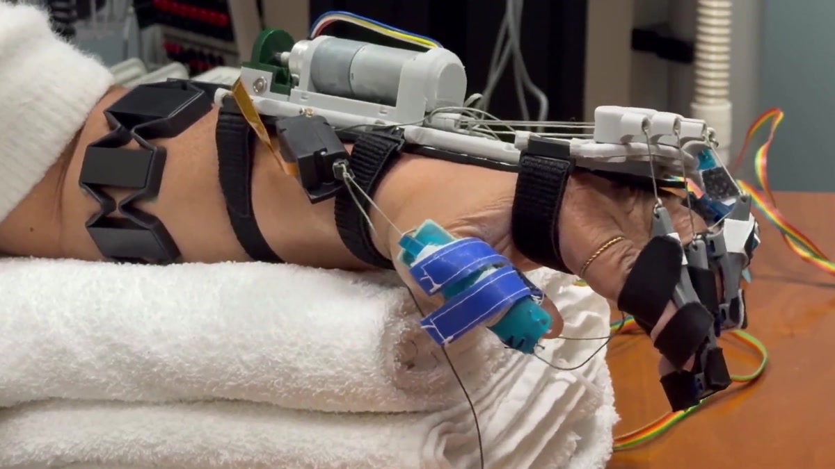 A stroke participant wearing the MyHand orthosis during real-time sEMG intent detection